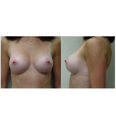 Natural Results From Breast Implant Surgery After